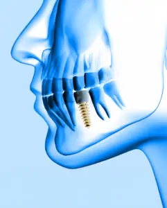 3D Guided Implant Surgery