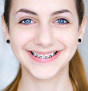 Orthodontic Braces
