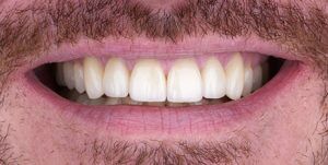 After Treatment Photo