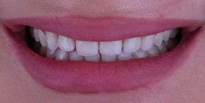 Before Treatment Photo