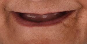 Before Treatment Photo