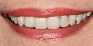 After Treatment Photo