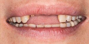 Before Treatment Photo
