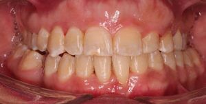 After Treatment Photo