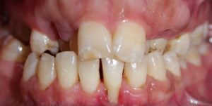Before Treatment Photo