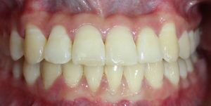 After Treatment Photo