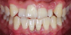 Before Treatment Photo