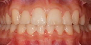 After Treatment Photo