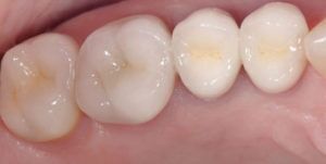 After Treatment Photo