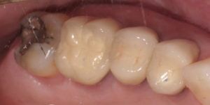 Before Treatment Photo