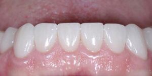 After Treatment Photo