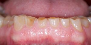 Before Treatment Photo