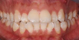 Before Treatment Photo